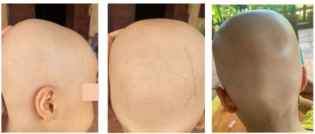 Bé gái 7 tuổi rụng hết tóc bất ngờ mọc kín đầu sau một năm- Ảnh 1. Bé gái 7 tuổi rụng hết tóc bất ngờ mọc kín đầu sau một năm- Ảnh 1.