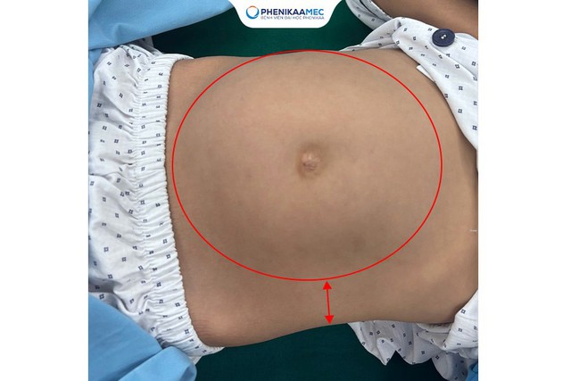 Phenikaa phẫu thuật thành công cho bé gái 9 tuổi mắc u quái buồng trứng 20 cm, bảo toàn khả năng sinh sản- Ảnh 1. Phenikaa phẫu thuật thành công cho bé gái 9 tuổi mắc u quái buồng trứng 20 cm, bảo toàn khả năng sinh sản- Ảnh 1.