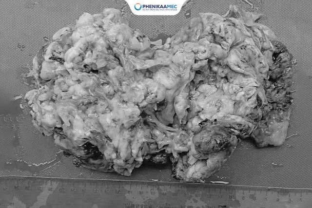 Phenikaa phẫu thuật thành công cho bé gái 9 tuổi mắc u quái buồng trứng 20 cm, bảo toàn khả năng sinh sản- Ảnh 3. Phenikaa phẫu thuật thành công cho bé gái 9 tuổi mắc u quái buồng trứng 20 cm, bảo toàn khả năng sinh sản- Ảnh 3.