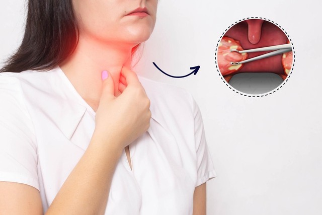 Khi amidan sưng to (thường là độ 3, độ 4) gây cản trở nghiêm trọng đến chức năng sinh hoạt Khi amidan sưng to (thường là độ 3, độ 4) gây cản trở nghiêm trọng đến chức năng sinh hoạt