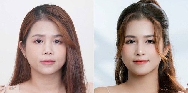 Vì sao nhiều người cần tái tạo mũi hỏng chỉ sau 1-2 năm?- Ảnh 3. Vì sao nhiều người cần tái tạo mũi hỏng chỉ sau 1-2 năm?- Ảnh 3.