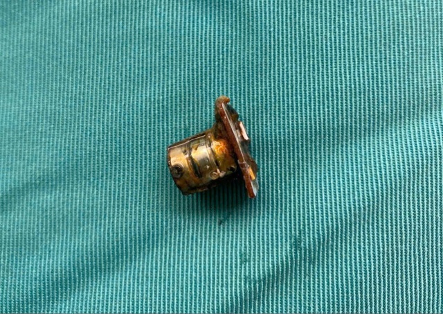 Cụm pin cúc áo trong thực quản bé trai 2 tuổi- Ảnh 2. Cụm pin cúc áo trong thực quản bé trai 2 tuổi- Ảnh 2.