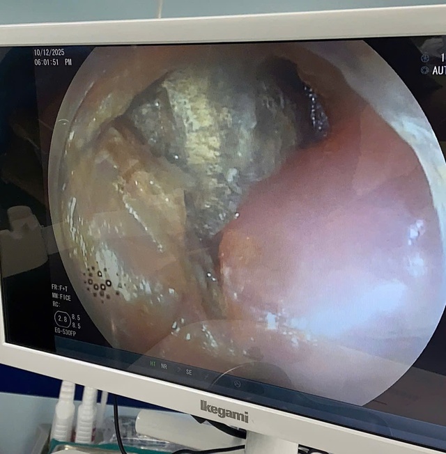 Cụm pin cúc áo trong thực quản bé trai 2 tuổi- Ảnh 1. Cụm pin cúc áo trong thực quản bé trai 2 tuổi- Ảnh 1.