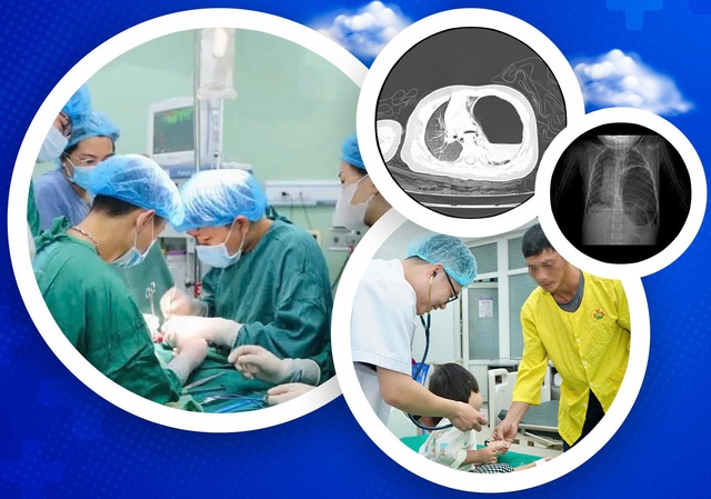 Phẫu thuật cấp cứu cứu sống trẻ 29 tháng tuổi bị thoát vị hoành nghẹt nguy hiểm- Ảnh 1. Phẫu thuật cấp cứu cứu sống trẻ 29 tháng tuổi bị thoát vị hoành nghẹt nguy hiểm- Ảnh 1.