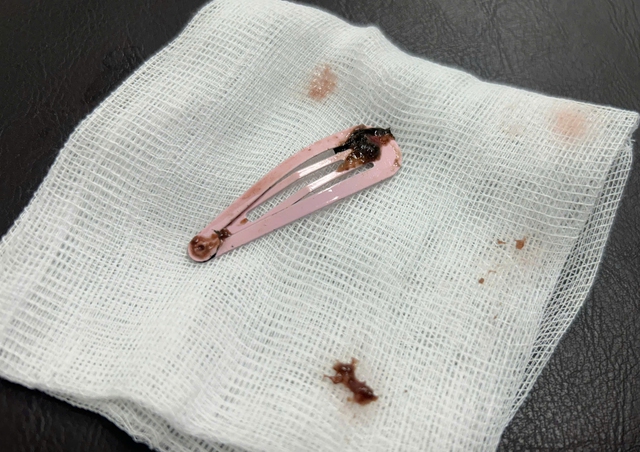 Bé 6 tuổi nhập viện cấp cứu vì nuốt kẹp tóc kim loại- Ảnh 1. Bé 6 tuổi nhập viện cấp cứu vì nuốt kẹp tóc kim loại- Ảnh 1.