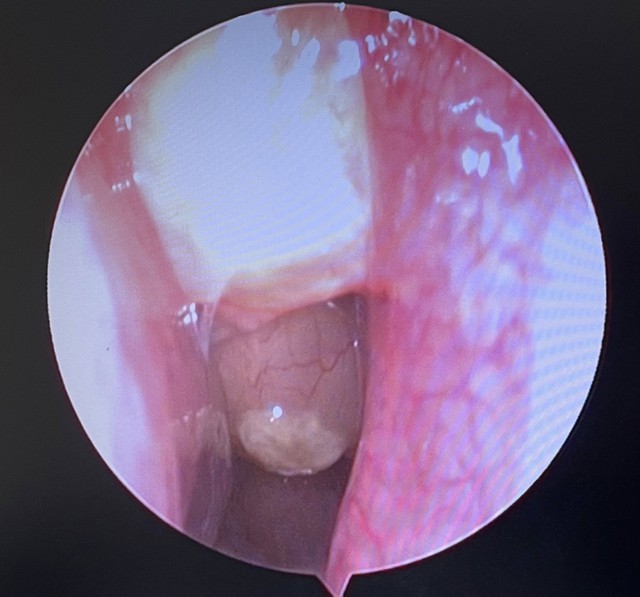 Phẫu thuật thành công cho bệnh nhân polyp mũi hai bên, viêm mũi xoang kèm hàng loạt bệnh lý nền nặng - Ảnh 1. Phẫu thuật thành công cho bệnh nhân polyp mũi hai bên, viêm mũi xoang kèm hàng loạt bệnh lý nền nặng - Ảnh 1.