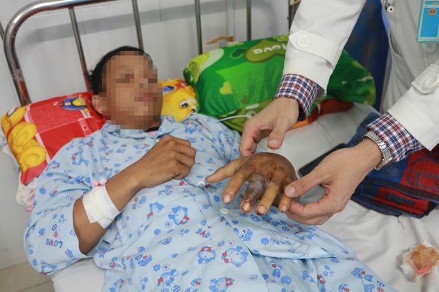 Bệnh viện tuyến tỉnh cứu sống nam thanh niên bị rắn cực độc cắn nguy kịch- Ảnh 1. Bệnh viện tuyến tỉnh cứu sống nam thanh niên bị rắn cực độc cắn nguy kịch- Ảnh 1.