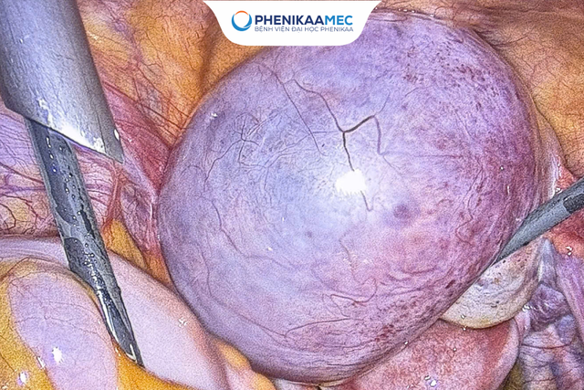 Top 6 biểu hiện u nang buồng trứng phụ nữ dễ bỏ qua- Ảnh 1.