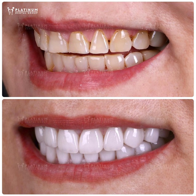 Dán răng sứ Veneer: Nụ cười đẹp phải đi cùng một hàm răng khỏe- Ảnh 3. Dán răng sứ Veneer: Nụ cười đẹp phải đi cùng một hàm răng khỏe- Ảnh 3.