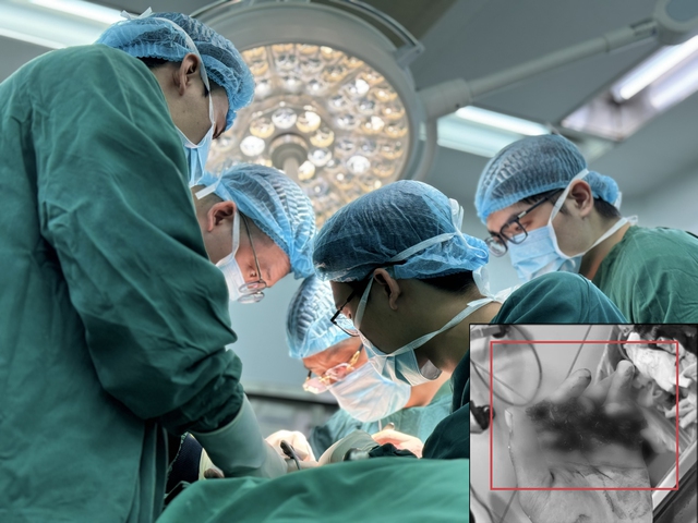 Nối thành công 4 ngón tay gần đứt rời cho bệnh nhân 25 tuổi- Ảnh 2. Nối thành công 4 ngón tay gần đứt rời cho bệnh nhân 25 tuổi- Ảnh 2.