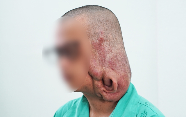 Bóc tách khối u sợi thần kinh khổng lồ gần 1 kg, trả lại diện mạo cho chàng trai trẻ- Ảnh 1. Bóc tách khối u sợi thần kinh khổng lồ gần 1 kg, trả lại diện mạo cho chàng trai trẻ- Ảnh 1.