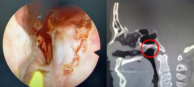 Người đàn ông chịu đau đầu suốt 40 năm vì dị vật ‘bỏ quên’ sâu trong mũi - Ảnh 1.