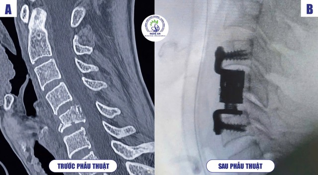 Phẫu thuật Cột sống tại Bệnh viện Chấn thương Chỉnh hình Nghệ An: Đột phá chuyên môn và phát triển vượt bậc- Ảnh 2.