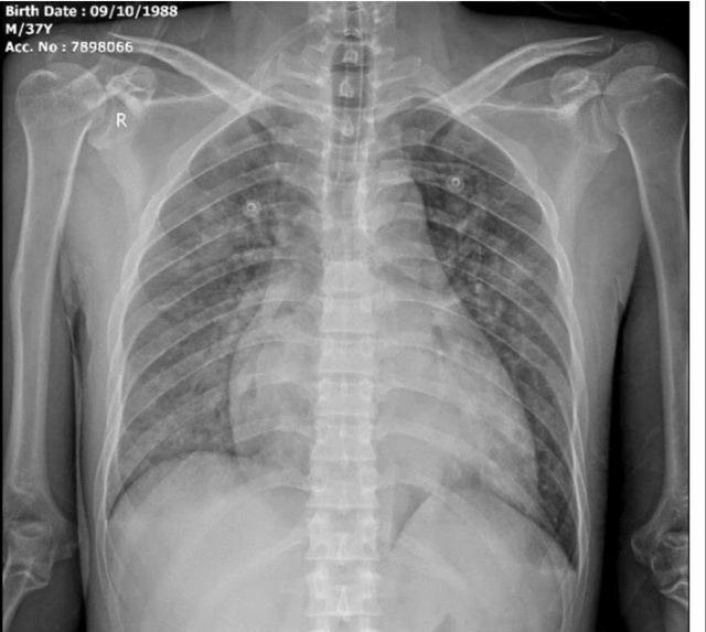 Cấp cứu thành công ca tăng kali máu nguy kịch, đe dọa ngừng tim- Ảnh 1.