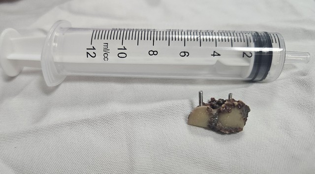 Hai chiếc răng giả bị bỏ quên trong phổi hơn 20 năm- Ảnh 1.