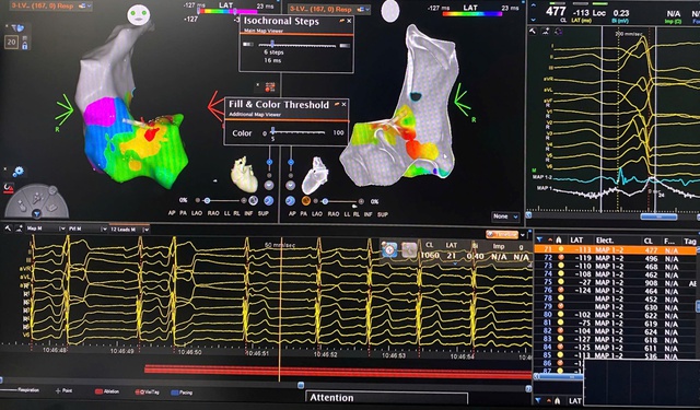 Công nghệ bản đồ tim 3D mở lối điều trị rối loạn nhịp phức tạp tại tuyến tỉnh- Ảnh 2.