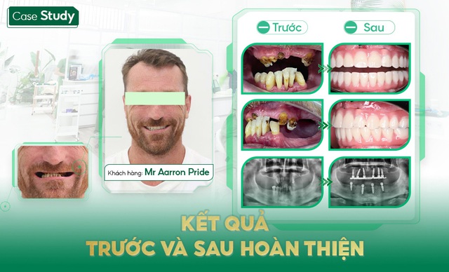 Nha khoa Santé Nha Trang – Điểm đến tin cậy cho cấy ghép Implant và phục hình răng sứ chất lượng cao- Ảnh 3.