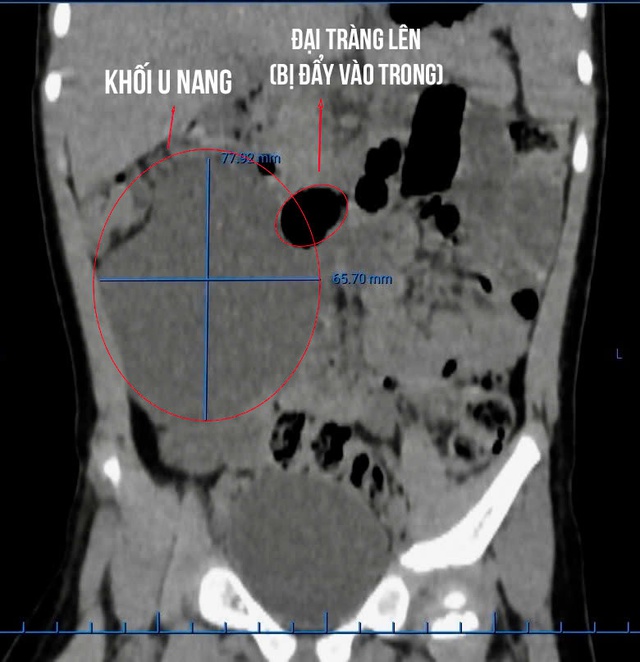 Cháu bé 26 tháng tuổi mắc khối u nang lớn, hiếm gặp, chèn ép gần một nửa vùng bụng phải- Ảnh 1. Cháu bé 26 tháng tuổi mắc khối u nang lớn, hiếm gặp, chèn ép gần một nửa vùng bụng phải- Ảnh 1.