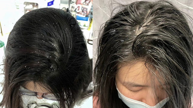 Da đầu gàu – ngứa kéo dài: 6 nguyên nhân ít ai ngờ tới khiến vấn đề trở nặng- Ảnh 1.