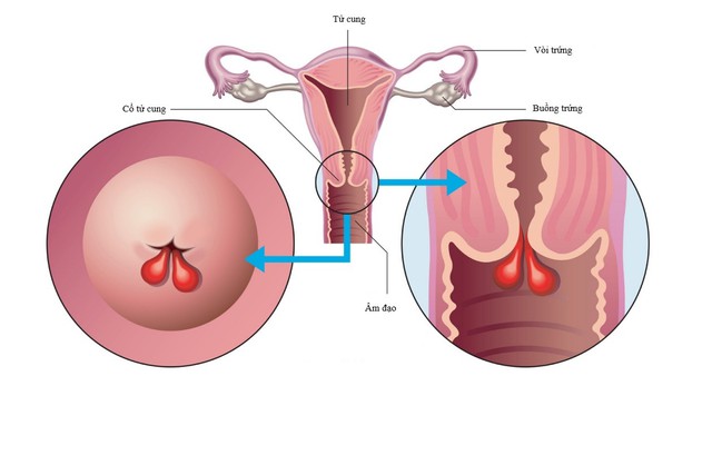 Polyp cổ tử cung có dẫn đến ung thư không? Bác sĩ chỉ ra nguy cơ cần cảnh giác- Ảnh 1.