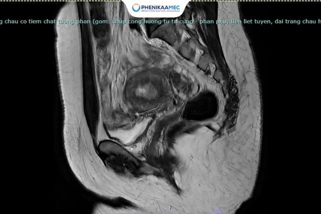 PhenikaaMec phát hiện và điều trị thành công ung thư nội mạc tử cung giai đoạn sớm ở phụ nữ hiếm muộn 10 năm- Ảnh 1.
