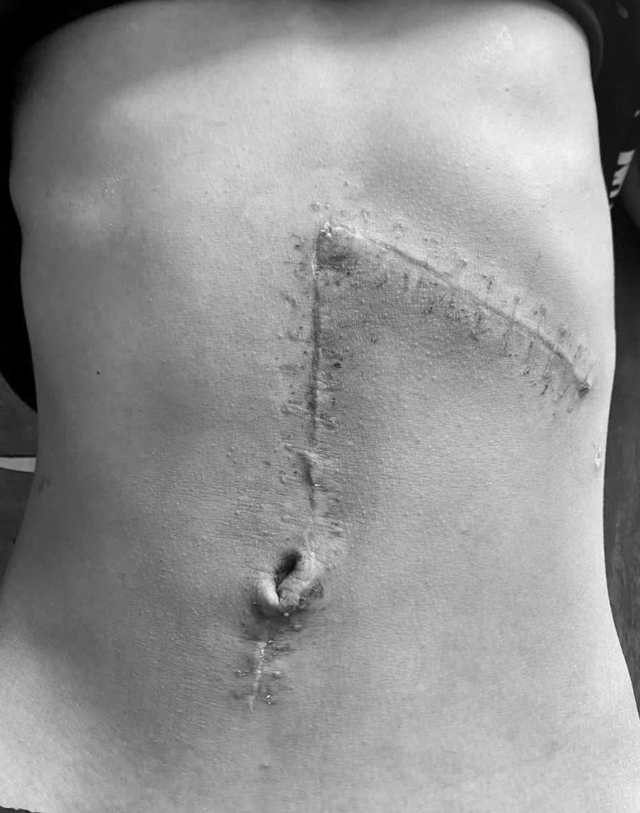 Cứu sống thiếu niên sốc mất máu do vỡ lách độ 5 sau tai nạn giao thông- Ảnh 1.