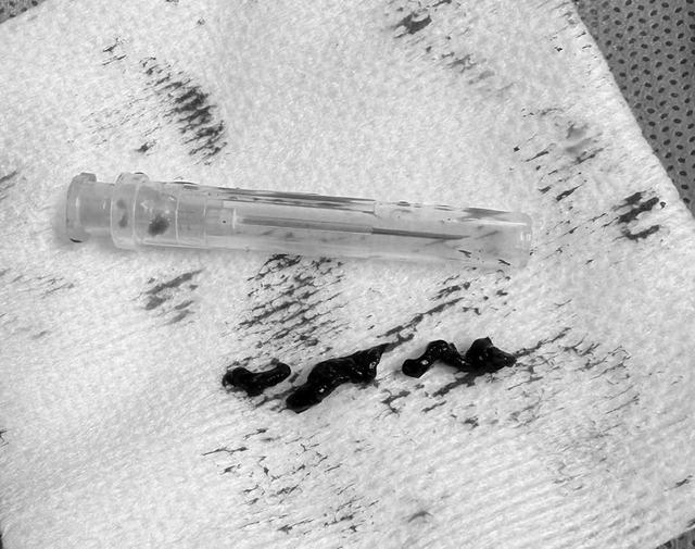 Cụ bà nhiều bệnh nền thoát chết sau cơn đột quỵ trong nhà vệ sinh- Ảnh 1.