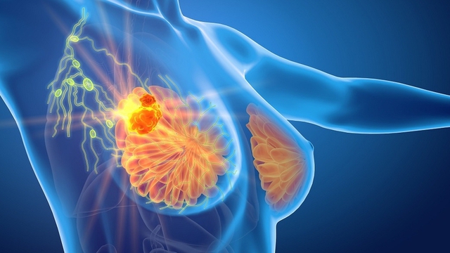 Ai nên chụp nhũ ảnh thường xuyên để phát hiện sớm ung thư vú?- Ảnh 1. Ai nên chụp nhũ ảnh thường xuyên để phát hiện sớm ung thư vú?- Ảnh 1.