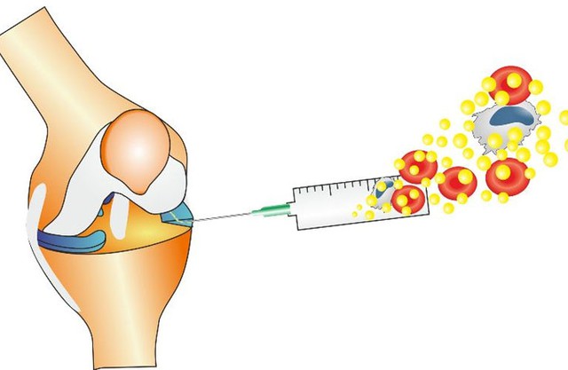 Điều trị chấn thương sụn chêm dựa vào hình thái, vị trí và kích thước của tổn thương. Ảnh minh họa