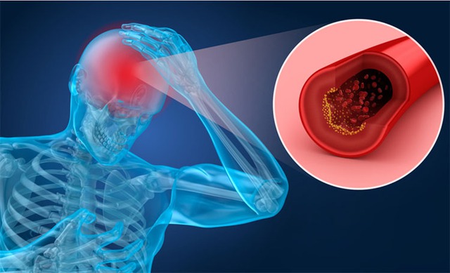 Thiếu máu lên não là tình trạng máu nuôi lên não không đủ, khiến tế bào não không được cung cấp đủ oxy và dưỡng chất cần thiết.