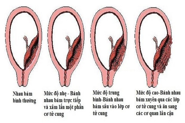 Bác sĩ vượt 100km cứu sản phụ rau cài răng lược nguy kịch- Ảnh 1.