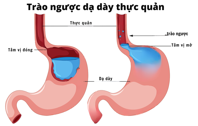 Ngăn ngừa ung thư thực quản do trào ngược bằng 'bộ đôi' Thắt tâm vị và đốt Argon Plasma- Ảnh 2.