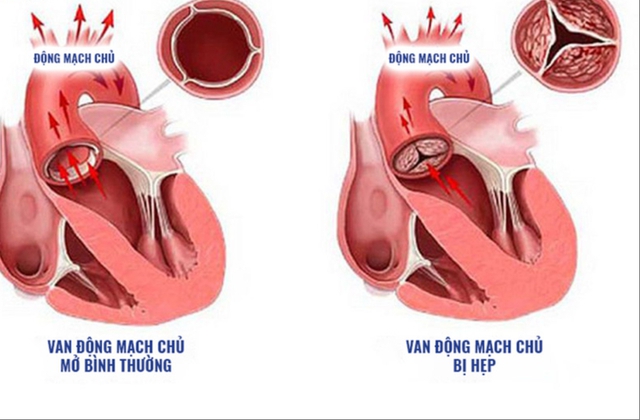 Hẹp van động mạch chủ là tình trạng van không thể mở ra hoàn toàn. Tình trạng này sẽ làm giảm hoặc chặn lưu lượng máu từ tim đi nuôi cơ thể.