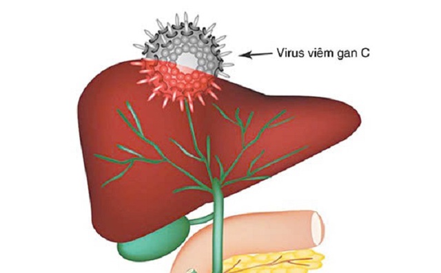 Viêm gan C: Nguyên nhân, triệu chứng, phòng ngừa và điều trị- Ảnh 1.