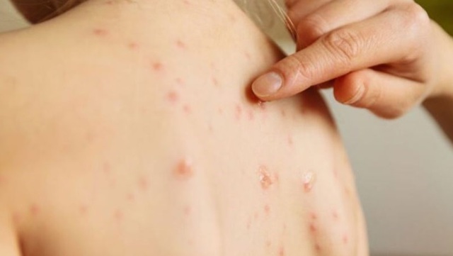 Bệnh sởi có thể bị mấy lần trong đời, làm sao để phòng ngừa?- Ảnh 2.