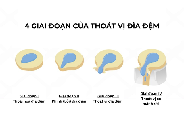 Nhận biết sớm các giai đoạn thoát vị đĩa đệm để điều trị hiệu quả- Ảnh 1.