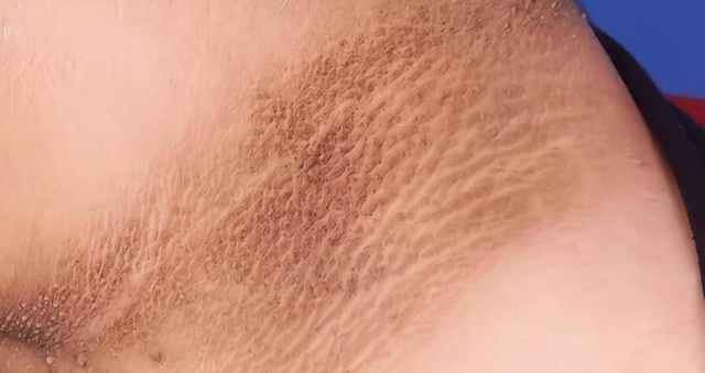 Bệnh gai đen: Nguyên nhân, biểu hiện, cách điều trị và phòng bệnh- Ảnh 2. Bệnh gai đen: Nguyên nhân, biểu hiện, cách điều trị và phòng bệnh- Ảnh 2.