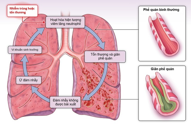 Giãn phế quản: Nguyên nhân, biểu hiện, cách điều trị và phòng bệnh- Ảnh 1. Giãn phế quản: Nguyên nhân, biểu hiện, cách điều trị và phòng bệnh- Ảnh 1.