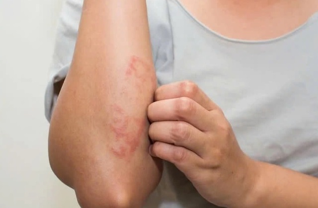 Câu hỏi thường gặp liên quan đến bệnh Lichen Nitidus- Ảnh 3. Câu hỏi thường gặp liên quan đến bệnh Lichen Nitidus- Ảnh 3.