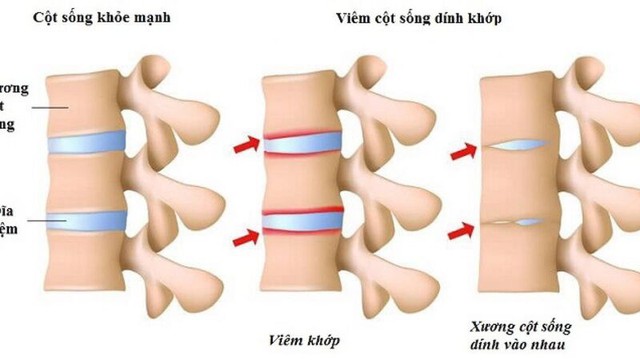 Viêm cột sống dính khớp: Nguyên nhân, triệu chứng, phòng ngừa và điều trị
- Ảnh 1. Viêm cột sống dính khớp: Nguyên nhân, triệu chứng, phòng ngừa và điều trị
- Ảnh 1.