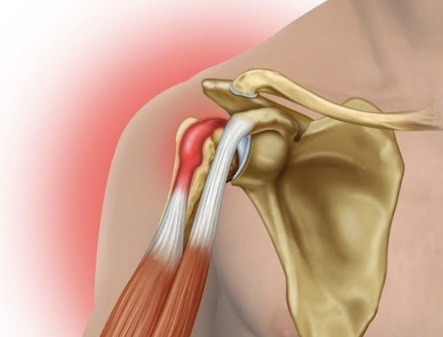 Viêm gân nhị đầu vai: Nguyên nhân, triệu chứng, cách điều trị và phòng ngừa- Ảnh 1. Viêm gân nhị đầu vai: Nguyên nhân, triệu chứng, cách điều trị và phòng ngừa- Ảnh 1.