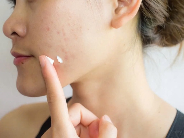 Da mụn nên trang điểm thế nào vừa che khuyết điểm vừa không gây bí da?- Ảnh 1. Da mụn nên trang điểm thế nào vừa che khuyết điểm vừa không gây bí da?- Ảnh 1.