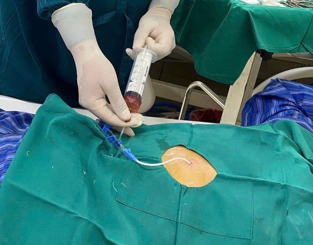 Cứu sống cụ ông tràn dịch màng ngoài tim do lao biến chứng- Ảnh 1. Cứu sống cụ ông tràn dịch màng ngoài tim do lao biến chứng- Ảnh 1.
