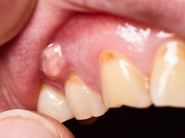 Đừng chủ quan với sưng mộng răng, nhiều người đã phải nhập viện vì bỏ qua dấu hiệu này- Ảnh 1. Đừng chủ quan với sưng mộng răng, nhiều người đã phải nhập viện vì bỏ qua dấu hiệu này- Ảnh 1.