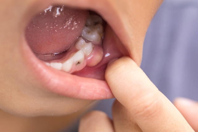 Đừng chủ quan với sưng mộng răng, nhiều người đã phải nhập viện vì bỏ qua dấu hiệu này- Ảnh 2. Đừng chủ quan với sưng mộng răng, nhiều người đã phải nhập viện vì bỏ qua dấu hiệu này- Ảnh 2.