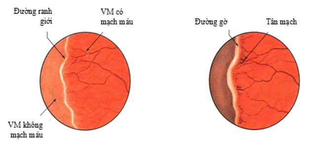 Bệnh lý võng mạc trẻ sinh non có thể gây mù lòa nếu không được điều trị kịp thời- Ảnh 2.