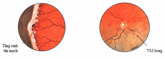 Bệnh lý võng mạc trẻ sinh non có thể gây mù lòa nếu không được điều trị kịp thời- Ảnh 3.