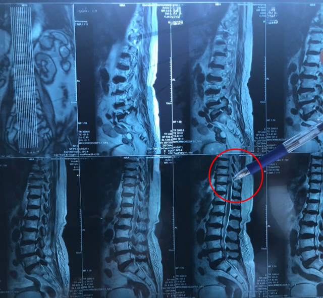 Cụ bà thoát yếu liệt, đi lại chỉ sau 1 ngày nhờ mổ thoát vị đĩa đệm bằng Robot AI- Ảnh 1. Cụ bà thoát yếu liệt, đi lại chỉ sau 1 ngày nhờ mổ thoát vị đĩa đệm bằng Robot AI- Ảnh 1.