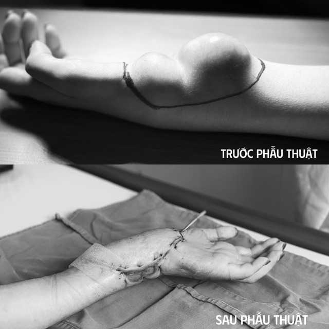 Mắc ung thư hiếm gặp, cô gái ở Hà Nội chịu cơn đau tay suốt 9 năm- Ảnh 1.