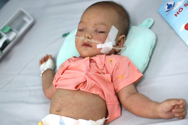 Bệnh tay chân miệng vào mùa, giải pháp nào ‘kìm hãm’?- Ảnh 2. Bệnh tay chân miệng vào mùa, giải pháp nào ‘kìm hãm’?- Ảnh 2.